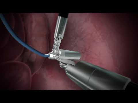 Laparoscopic gamma probe — sentinel-node access through the trocar
