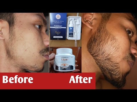 Beard Growth Oil  | Dadhi badhane ke liye kya karu
