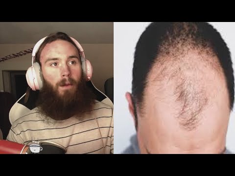 Nerdperior talks about balding at 19