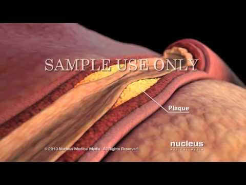 V248 hight cholesterol