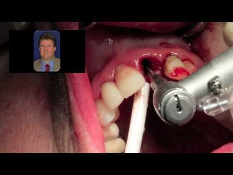 Immediate Dental Implant Surgery