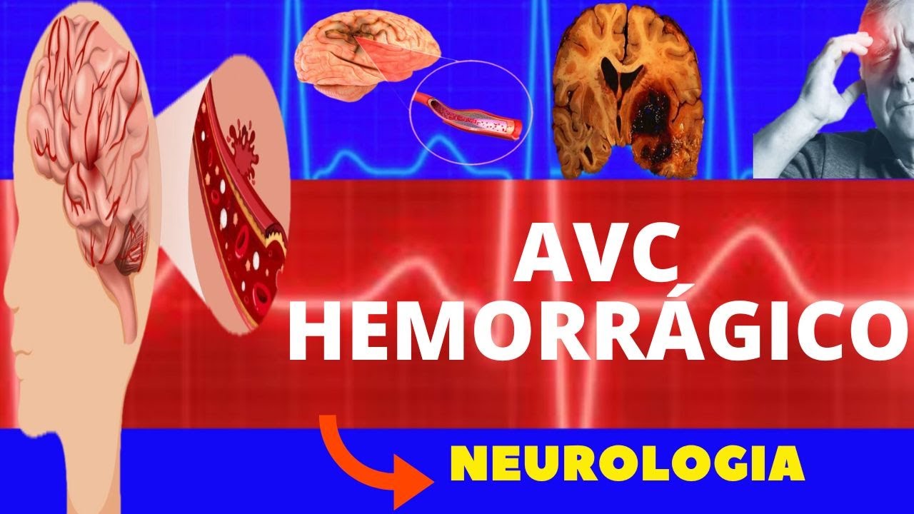 ACIDENTE VASCULAR CEREBRAL HEMORRÁGICO (CAUSAS, SINTOMAS, DIAGNÓSTICO E TRATAMENTO) AVC HEMORRÁGICO