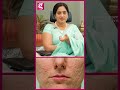 Acne Pores-அ Ointment -ல சரி பண்ண முடியாது! - Dr. Shwetha Rahul MD. DVL | Skin Care