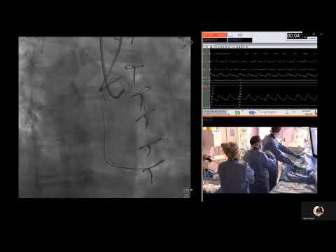 Retrograde PCI for Complex RCA CTO