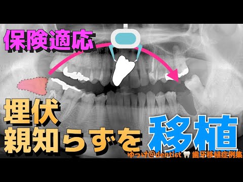 生命歯学科 【歯牙移植症例集】保険治療で歯の移植ができる⁉️埋伏した親知らずを使った抜歯後待機歯牙移植を解説🦷通常の歯の移植と何が違うのか❓自費の移植と何が違うのか❓どうなの❓を解説していきます‼️