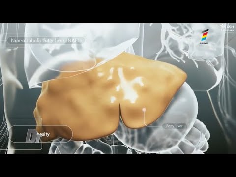 Boala ficatului gras. Cauze, simptome și cum îl putem vindeca