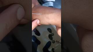 Cannulation video part 1014 #shorts #viral #trending