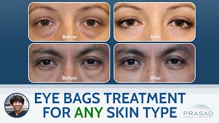 Treating Under Eye Bags in Any Skin Type