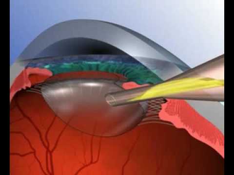 Oftan-katachrom szemcsepp a látás javítása érdekében