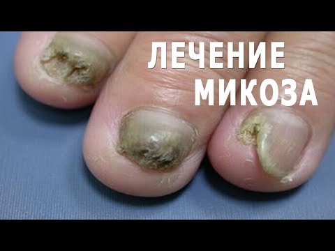 Лікування gribka auf den Beinen die Salbe Wie die Haut der Hände von gribka der Nägel zu behandeln
