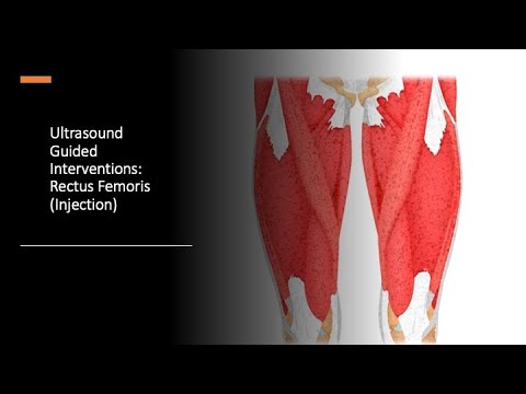 #ultrasound Guided Interventions: Rectus Femoris (Injection) #fyp #sport #sports #sportsmedicine