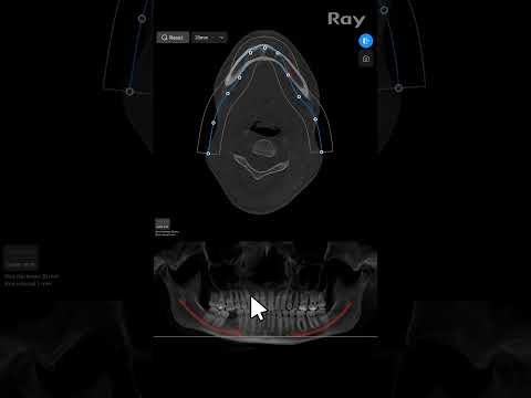 SMARTDent : 5D Tutorial #2-4. Edit the Auto Arch