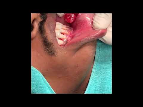 Large Lower Lip Mucous Retention Cyst