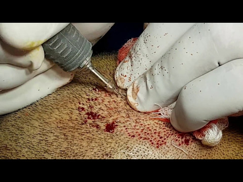 Remarkable Results of Hair Transplant Surgery Treatment in Punjab