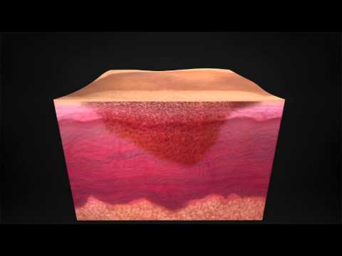 La canzone il sole ha presentato lentiggini lucenti Prezzo di eliminazione laser di un posto di pigmentary