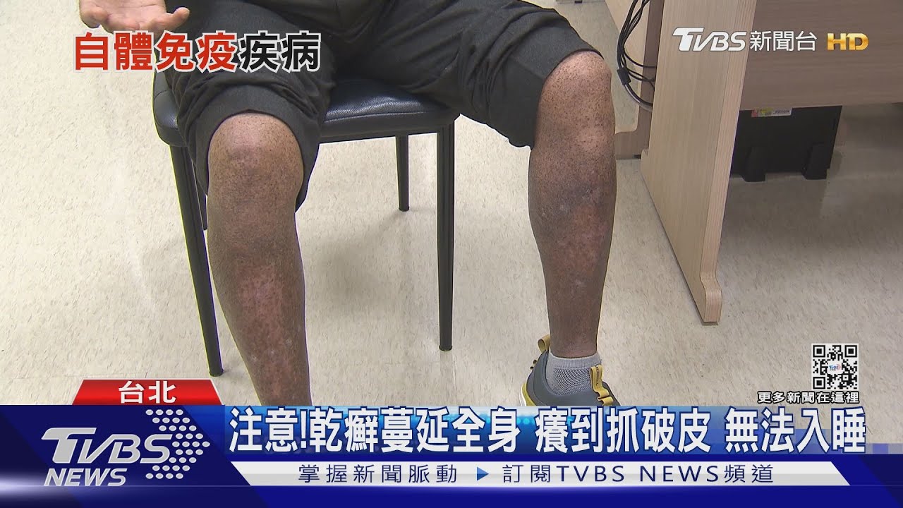 有片/輕忽「自體免疫疾病」!症狀難以想像 醫警告別延誤就醫