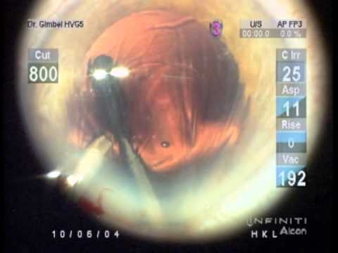 Capsulorhexis postérieur pour une hyalose astéroïde