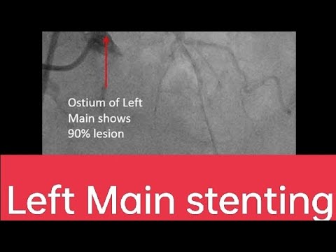 Left main PCI #PTCA #Stenting angiogram #cardiology #Intervention cardiology