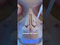 How A Nose Surgery Works