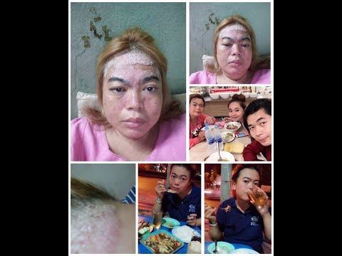 กลากอาการผิวหนังรูปภาพ ไตและโรคสะเก็ดเงิน