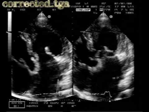  Korrigierte Transposition der großen Arterien, ventrikulärer Septumdefekt und Pulmonalklappenstenose