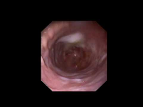 comment soigner gastrite