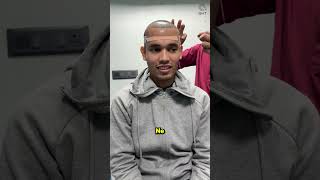 Amazing Hair Transplant Surgery | Latest Fue Technique #shorts #viral 