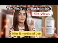 The Ordinary Niacinamide 10 Zinc 1 Review WHAT ARE THE RESULTS After 6 Months Of USE