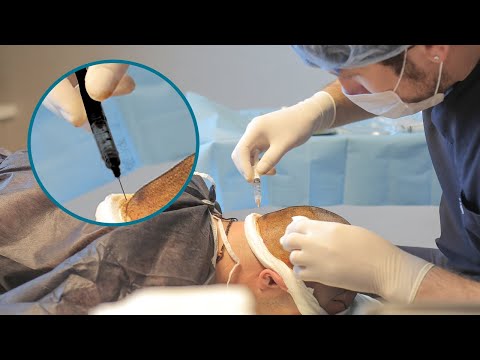 2nd YouTube video about are hair transplants painful
