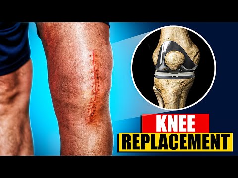 Total Knee Replacement Surgery 3D Animation | 3D Animation of a Knee Replacement | Joint Replacement