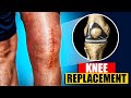 Total Knee Replacement Surgery 3D Animation 3D Animation Of A Knee Replacement Joint Replacement