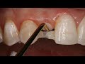 Direct Resin Bonded Bridge | Dental Online Training