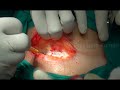 Opening The Abdomen