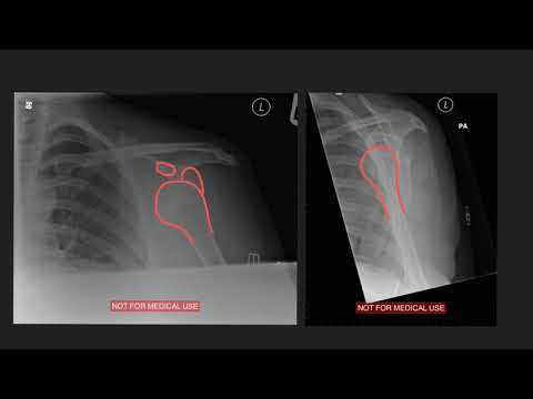 Shoulder dislocation