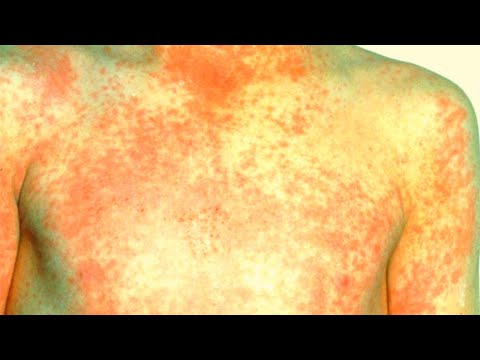 Scarlet Fever in 2 minutes, Symptoms, Signs, Causes, Diagnosis, Treatment, USMLE