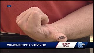 Wisconsin monkeypox survivor recalls 2003 outbreak