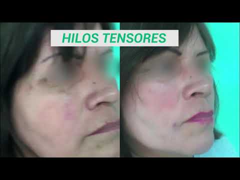 Tratamiento con Hilos Tensores