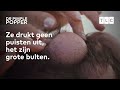 Een man hoopt dat Dr. Sandra Lee hem van zijn bulten af kan helpen.