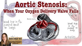 Aortic Stenosis: When Your Oxygen Delivery Valve Fails