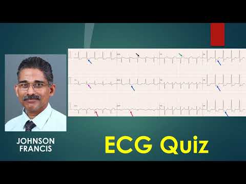 ECG Quiz   Multiple ECGs