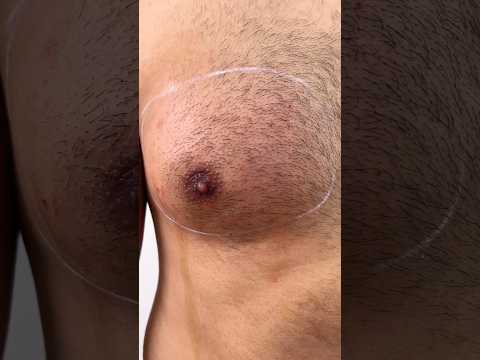 Du leidest unter einer Männerbrust? Jetzt FOLGEN und mehr erfahren!