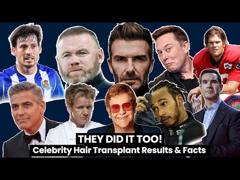 THEY DID IT TOO! | Celebrity Hair Transplant Results & Facts | SMILE HAIR CLINIC