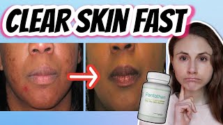 Does pantothenic acid (B5) CLEAR SKIN?| Dr Dray