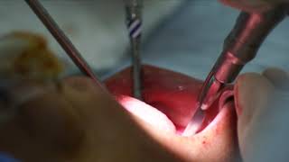 MENTOPLASTIA DE REDUCCIÓN