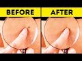 10 Effective Ways to Remove Skin Tags Naturally 10 Effective Ways to Remove Skin Tags Naturally