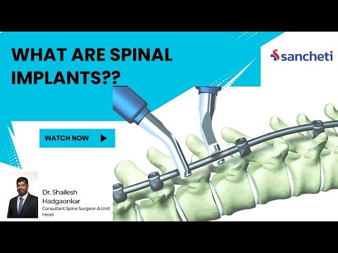 What Are Spinal Implants? | स्पाइनल इम्प्लांट्स म्हणजे काय? | Dr. Shailesh Hadgaonkar