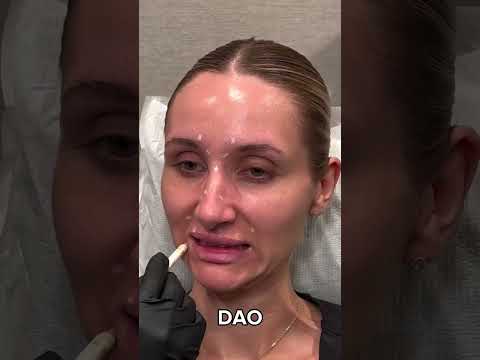 Where Should I Get Botox? Here's a Guide To Different Tox Placements