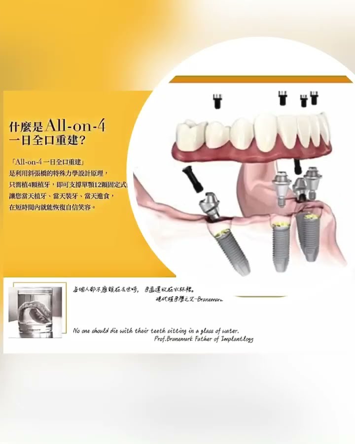 15秒瞭解 All-On-4