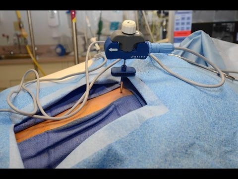 STAR Tumor Ablation System