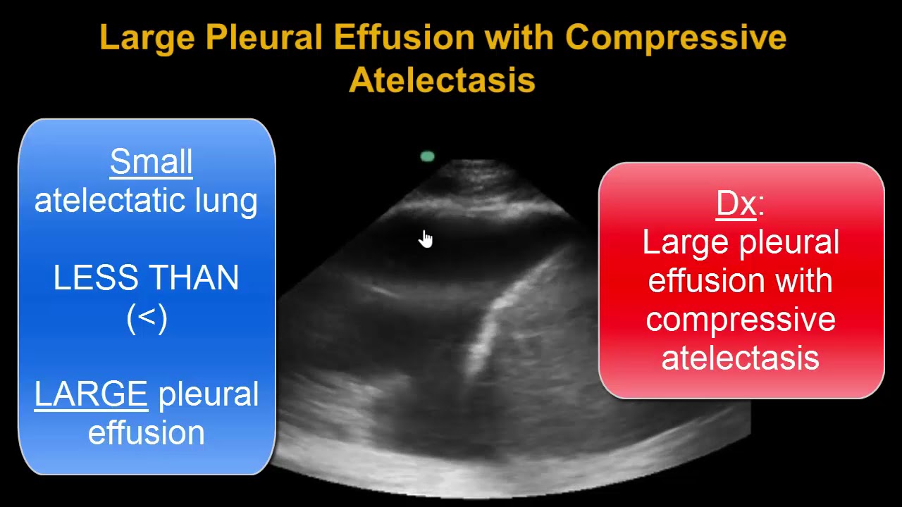 Lung Ultrasound: Consolidation - Atelectasis or Pneumonia?